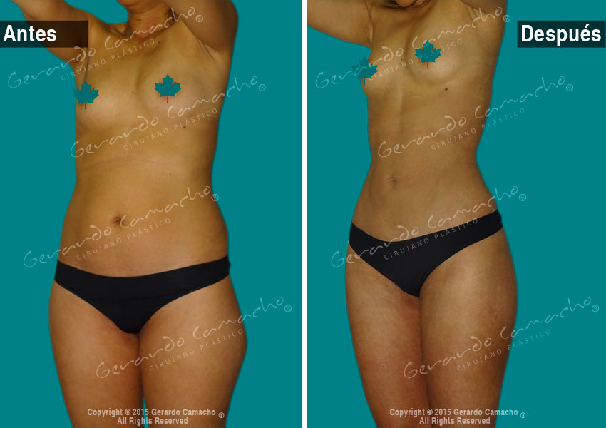 Antes y después de lipólisis láser en abdomen en Bogotá